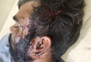 सचिन के सिर में लगी चोट